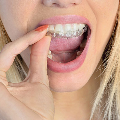 Invisalign®