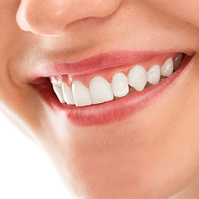 Teeth Whitening